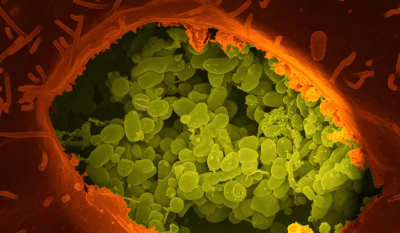 Μελιοείδωση: Η σπάνια θανατηφόρα λοίμωξη που προκαλείται από βακτήρια - Πού βρέθηκαν κρούσματα
