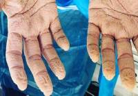 Τα χέρια νοσηλευτή του ΕΟΔΥ μετά από 8 συνεχόμενες ώρες διενέργειας τεστ
