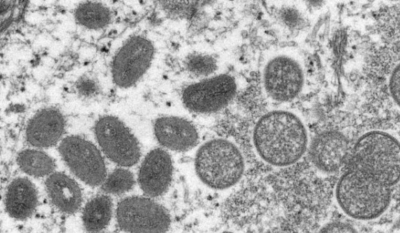 Ευλογιά των πιθήκων: Δεν υπάρχουν αποδείξεις για μετάλλαξη του ιού, λέει ο ΠΟΥ