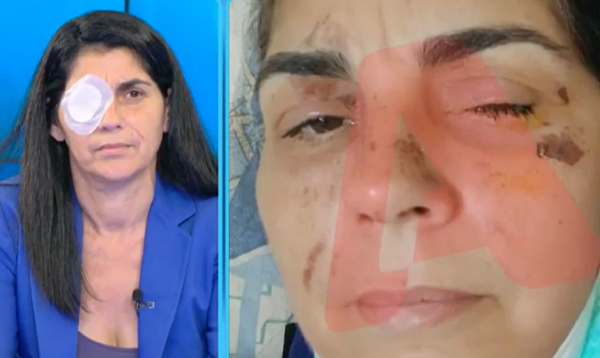 «Πονούσα, ούρλιαζα, καιγόμουν» - Η 49χρονη μιλά για την επίθεση με οξύ στη Μεσσήνη