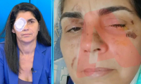 «Πονούσα, ούρλιαζα, καιγόμουν» - Η 49χρονη μιλά για την επίθεση με οξύ στη Μεσσήνη