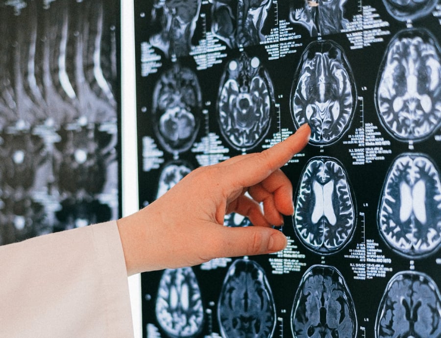 Νέα θεραπεία κατά του Αλτσχάιμερ: Οι επιστήμονες κέρδισαν την άμυνα του εγκεφάλου - Ανάλυση MIT