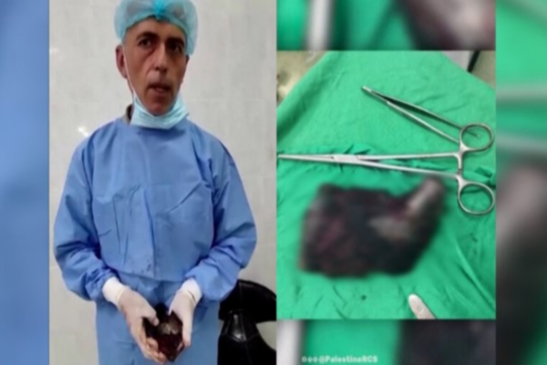 Γάζα: Θραύσμα οβίδας βάρους ενός κιλού αφαιρέθηκε από τραυματία