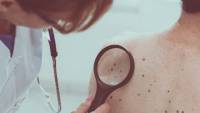 Καρκίνος του δέρματος: Πότε είναι «ύποπτος» για μετάσταση