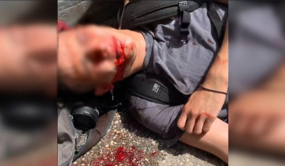 Εικόνα φρίκης: Τα ΜΑΤ τραυμάτισαν φοιτητή στη Θεσσαλονίκη – Κινδυνεύει να χάσει την ακοή του