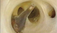 Αποκρουστικό βίντεο: Σκουλήκια στριφογυρίζουν στην κοιλιά 70χρονου