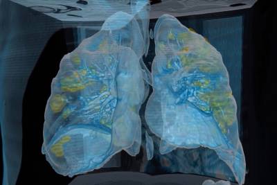 Κορονοϊός: Δείτε πώς ο ιός καταστρέφει τους πνεύμονες - Τρισδιάστατο βίντεο