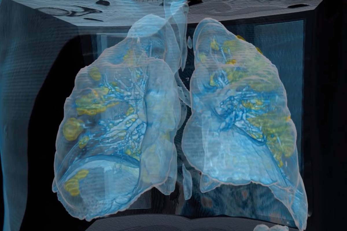 Κορονοϊός: Δείτε πώς ο ιός καταστρέφει τους πνεύμονες - Τρισδιάστατο βίντεο