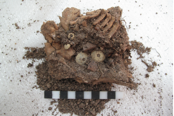 A Remarkable Discovery: Down Syndrome Unearthed in Ancient Greek Burial Ground