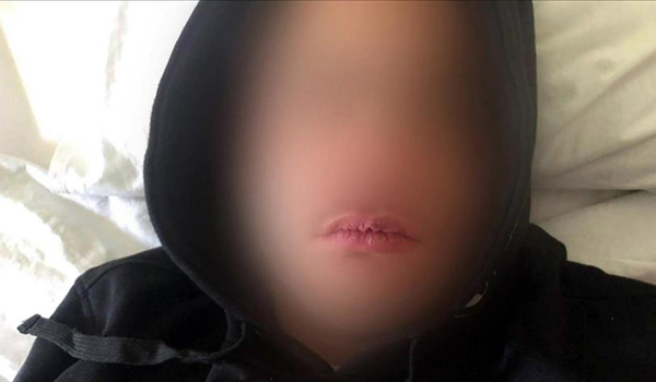 Λουτράκι: «Έσπασαν το σαγόνι του παιδιού μου» λέει η μητέρα του μαθητή που ξυλοκοπήθηκε