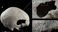 Ισπανία: Επιστήμονες βρήκαν αρχαίο κρανίο με δύο τρύπες - Τι ανακάλυψαν