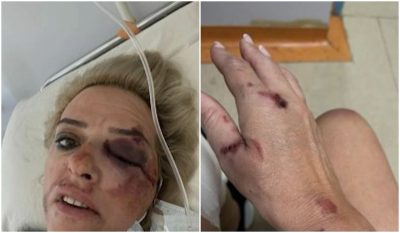 Καλαμάτα: Επίθεση αδέσποτων σε γυναίκα - Έκανε ελιγμό με την μηχανή της και τραυματίστηκε σοβαρά