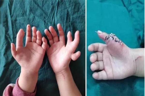 Κοριτσάκι γεννήθηκε με 14 δάχτυλα στα χέρια