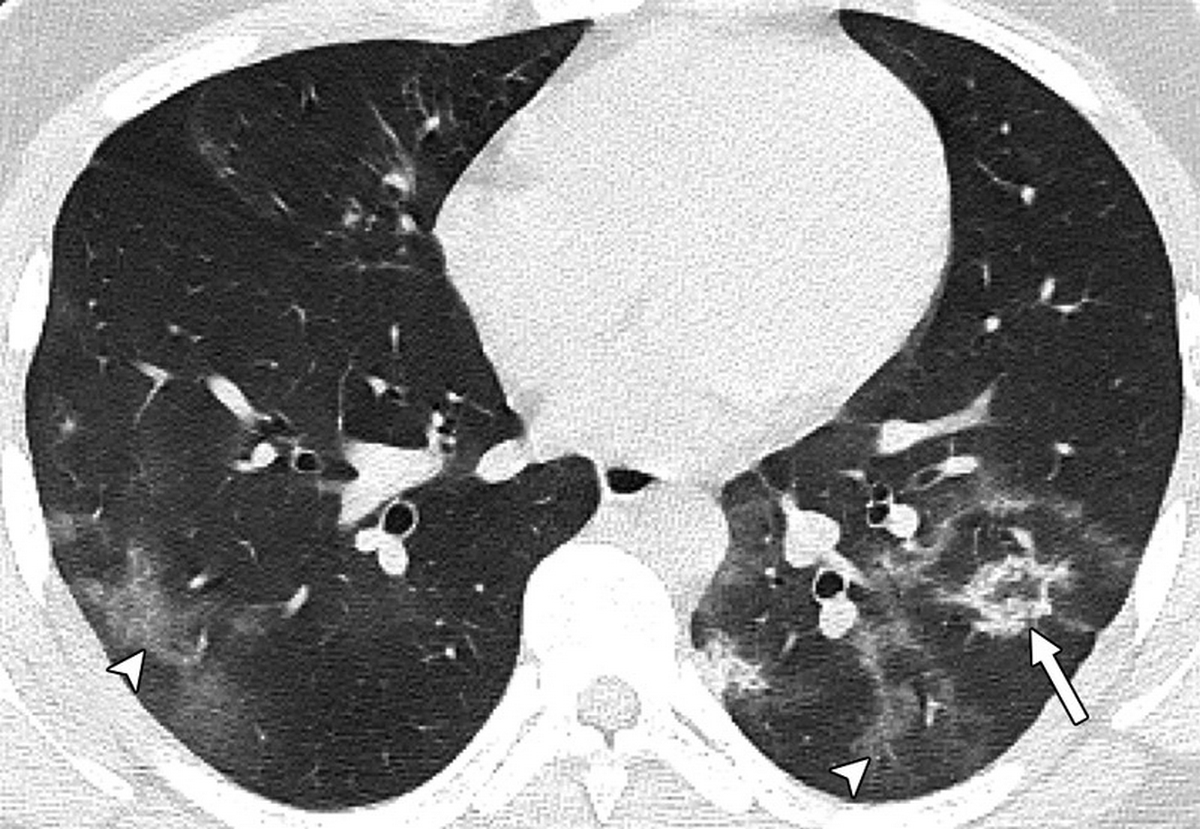 Οι βλάβες στους πνεύμονες ανηλίκων που νόσησαν με κορονοϊό - Ανάρτηση Μαγιορκίνη
