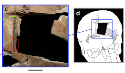 Βρήκαν ανθρώπινο κρανίο 3.500 ετών που είχε τετράγωνη τρύπα - Ο πιθανότερος λόγος
