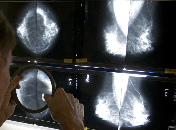 Καρκίνου του μαστού: Επιστήμονες δημιούργησαν συσκευή για το σουτιέν που παρακολουθεί τους όγκους - Πώς λειτουργεί