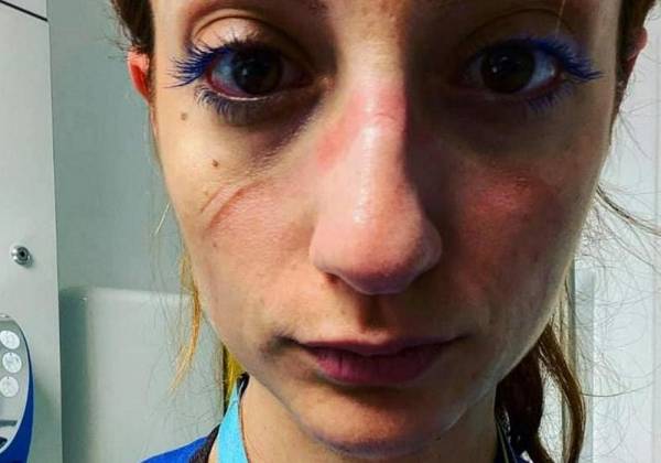 Κορονοϊός: Συγκλονίζει Ελληνίδα αναισθησιολόγος του νοσοκομείου της Οξφόρδης-«Αυτό είναι το πρόσωπό μου»