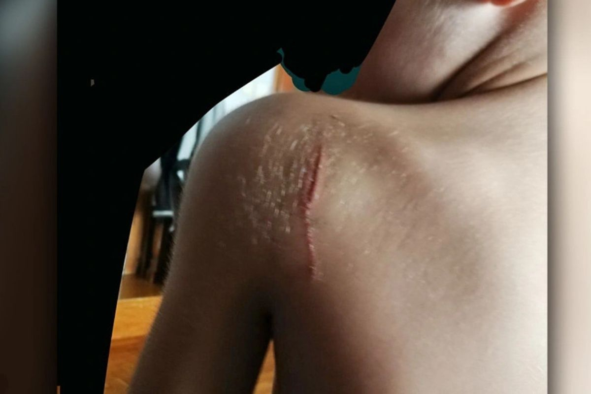 Μαχαίρωσαν 11χρονο στη Θεσσαλονίκη: «Χθες με χτύπησαν ξανά γιατί είπε ο μπαμπάς μου ότι με βαράνε», αποκαλύπτει