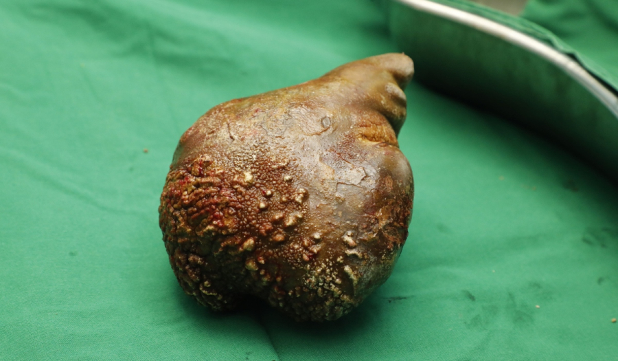 Αφαίρεσαν πέτρα από τα νεφρά βάρους 800 γραμμαρίων - Η μεγαλύτερη που έχει καταγραφεί ποτέ (Βίντεο)