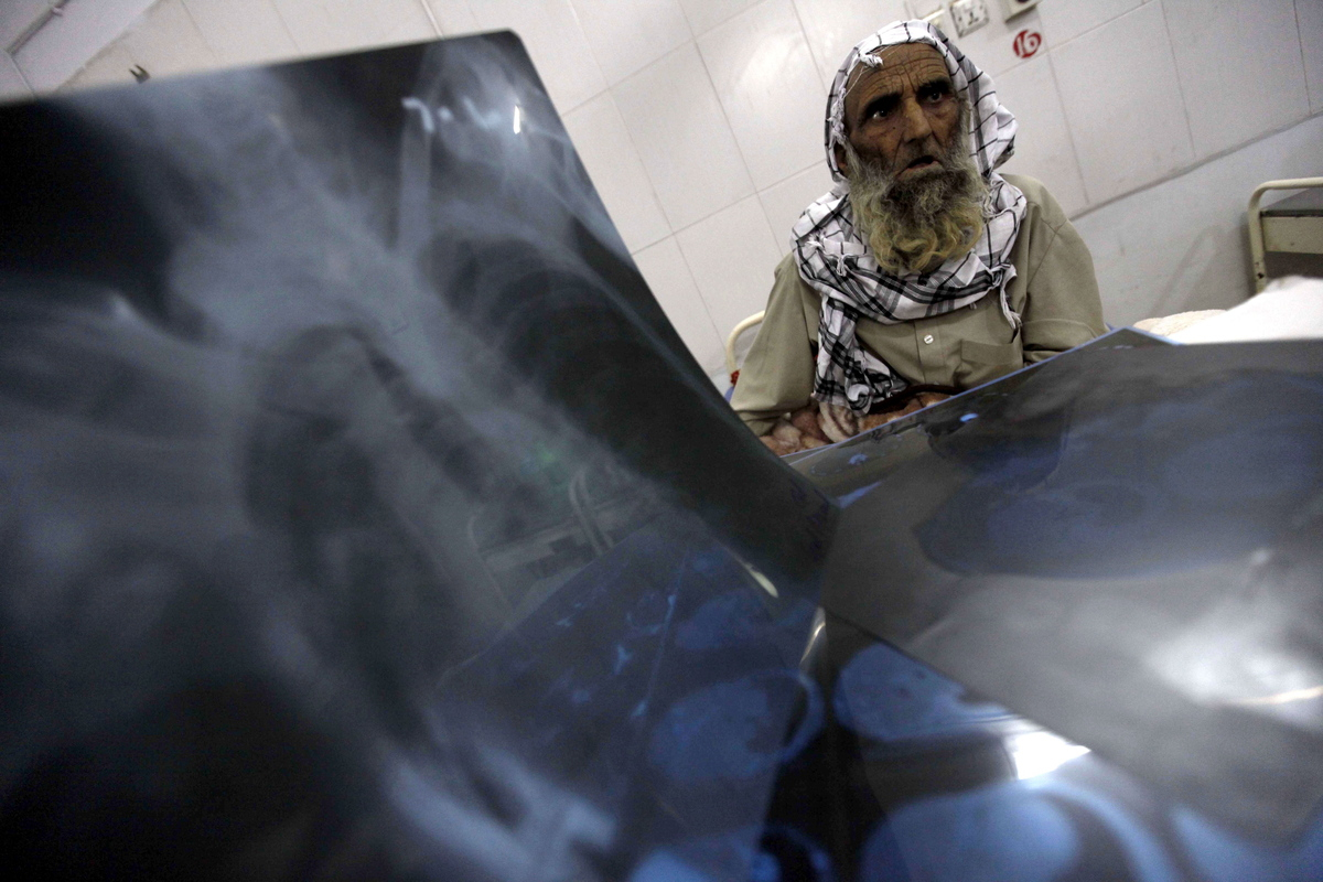 ΠΟΥ: Η φυματίωση επιστρέφει δυναμικά - 1,6 εκατ. οι θάνατοι το 2021
