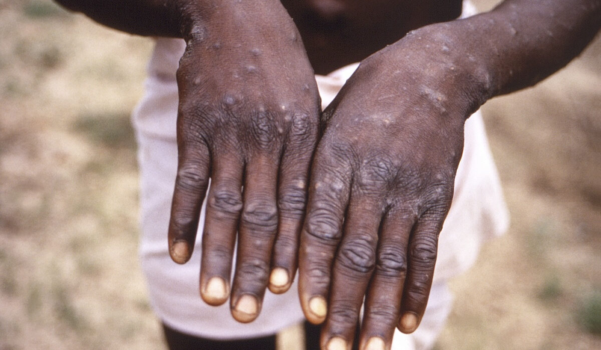 Ιός mpox: Πώς μεταδίδεται η ευλογιά των πιθήκων – Οι οδηγίες του ΕΟΔΥ και ο εμβολιασμός