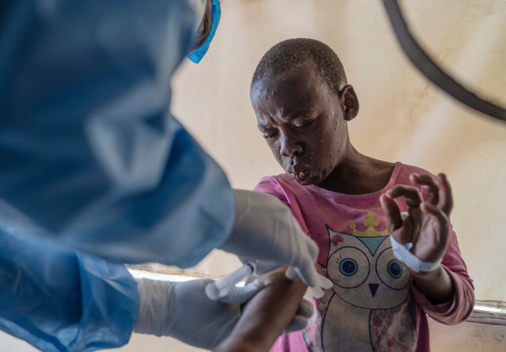 Γιατί ο ιός Mpox δεν θα γίνει ο νέος κορονοϊός – Τι λέει ο Παγκόσμιος Οργανισμός Υγείας