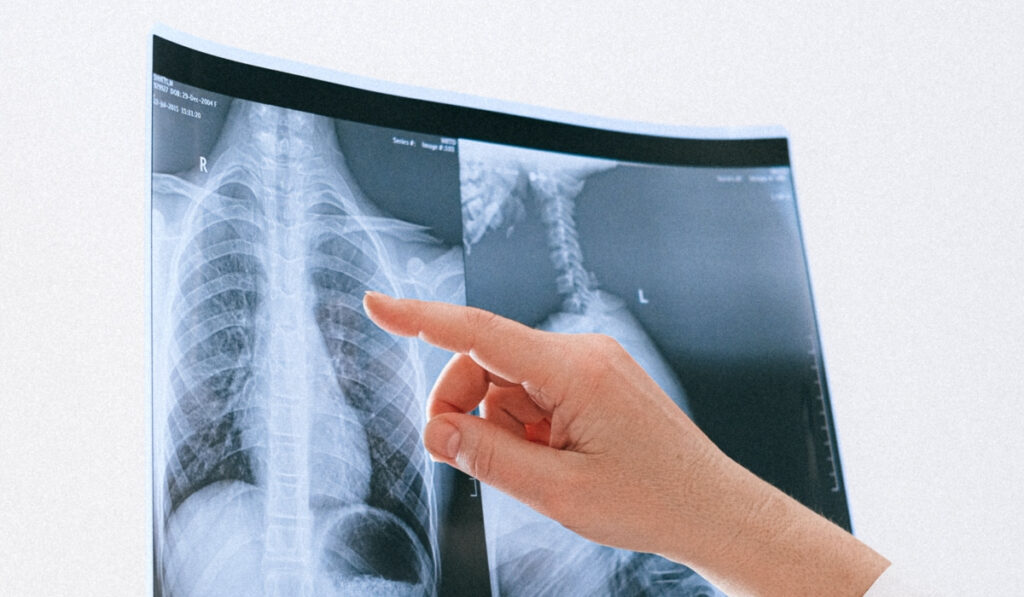 Η Καρδιολογική Εταιρεία για την Πνευμονική Υπέρταση: Πρόγνωση, συμπτώματα και αντιμετώπιση της νόσου