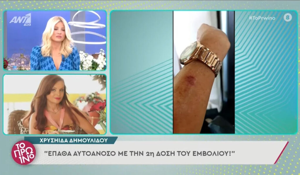 Χρυσηίδα Δημουλίδου: Έκανα δεύτερη δόση του εμβολίου και έπαθα λύκο – Οι εικόνες