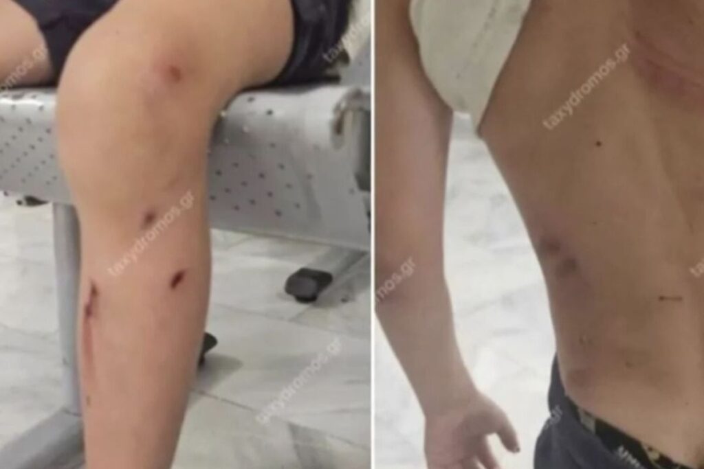 Βόλος: Αδέσποτα σκυλιά επιτέθηκαν σε 7χρονο – Τον δάγκωσαν σε όλο το σώμα