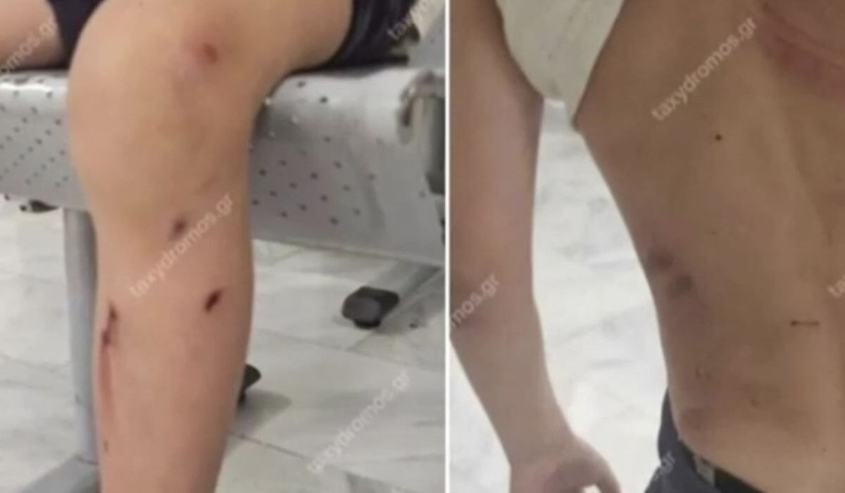 Βόλος: Αδέσποτα σκυλιά επιτέθηκαν σε 7χρονο – Τον δάγκωσαν σε όλο το σώμα